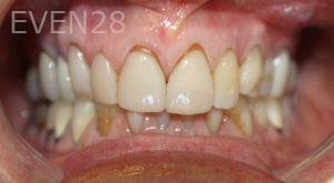 Dana-Nichols-Dental-Crowns-before-3