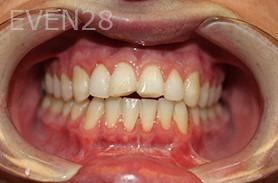 Dana-Nichols-Dental-Crowns-before-4