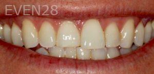 Daniele-Green-Dental-Crowns-before-1
