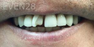 Daniele-Green-Dental-Crowns-before-2