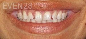 Daniele-Green-Laser-Gingivectomy-Gum-Recontouring-after-1