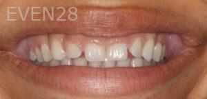 Daniele-Green-Laser-Gingivectomy-Gum-Recontouring-before-1
