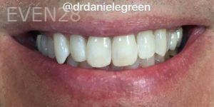 Daniele-Green-Teeth-Whitening-after-1