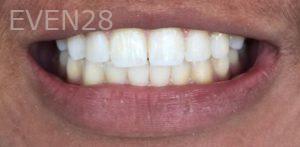 Daniele-Green-Teeth-Whitening-after-2