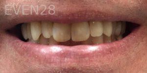 Daniele-Green-Teeth-Whitening-before-1