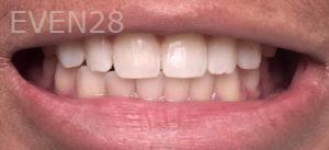 Daniele-Green-Teeth-Whitening-before-2