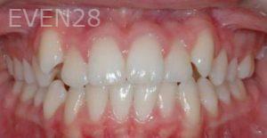 David-Moradi-Orthodontic-Braces-before-2b