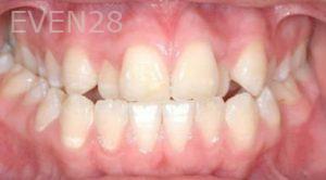 David-Moradi-Orthodontic-Braces-before-5b