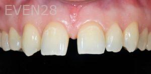 David-Schlang-Dental-Crowns-before-4