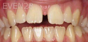 David-Schlang-Invisalign-Clear-Aligners-before-1