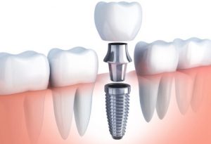 Dental-implant-complete-1