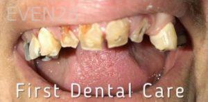 Douglas-Kim-Dental-Crowns-before-1