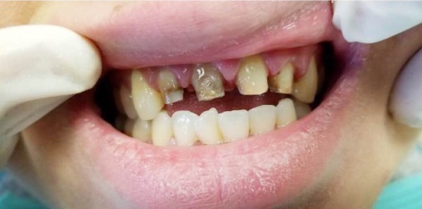 Douglas-Kim-Dental-Crowns-before-2