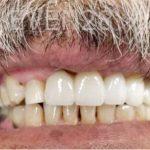 Douglas-Kim-Dental-Implants-after-1