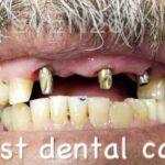 Douglas-Kim-Dental-Implants-before-1