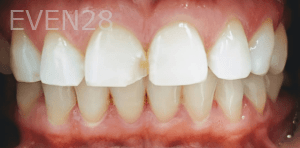 Elmira-Elahi-Dental-Bonding-before-1