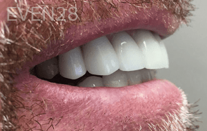 Elmira-Elahi-Dental-Crowns-after-2b