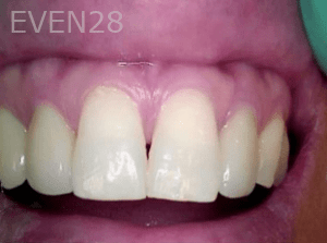 Elmira-Elahi-Dental-Crowns-after-3