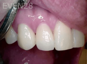 Elmira-Elahi-Dental-Crowns-after-3b