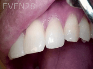 Elmira-Elahi-Dental-Crowns-after-3c