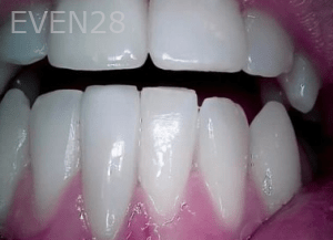 Elmira-Elahi-Dental-Crowns-after-4