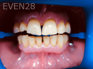 Elmira-Elahi-Dental-Crowns-before-1