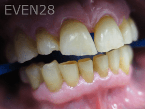 Elmira-Elahi-Dental-Crowns-before-1b