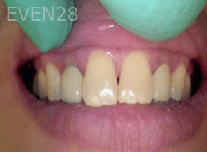 Elmira-Elahi-Dental-Crowns-before-3