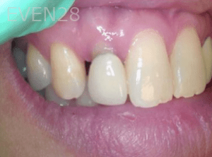 Elmira-Elahi-Dental-Crowns-before-3b