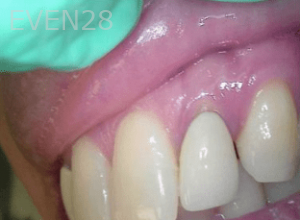 Elmira-Elahi-Dental-Crowns-before-3c