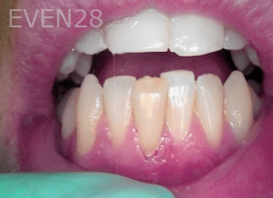 Elmira-Elahi-Dental-Crowns-before-4