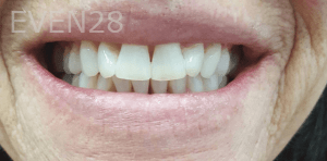 Elmira-Elahi-Teeth-Whitening-after-2