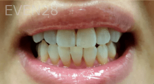 Elmira-Elahi-Teeth-Whitening-after-3