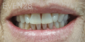 Elmira-Elahi-Teeth-Whitening-before-2