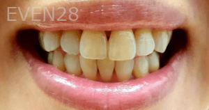 Elmira-Elahi-Teeth-Whitening-before-3