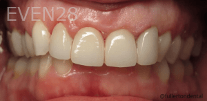 Eric-Meyer-Dental-Crown-after-1
