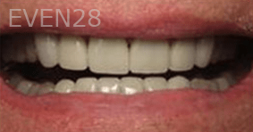 Eric-Meyer-Dental-Crown-after-3