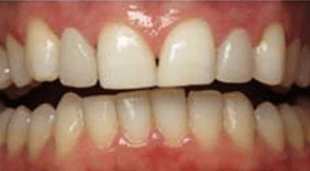 Eric-Meyer-Dental-Crown-after-4