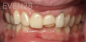 Eric-Meyer-Dental-Crown-before-1