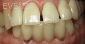 Eric-Meyer-Dental-Crown-before-2