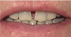 Eric-Meyer-Dental-Crown-before-3