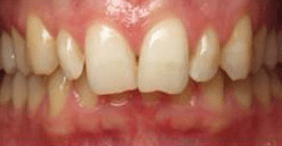 Eric-Meyer-Dental-Crown-before-4
