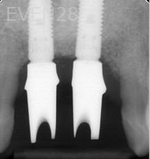 Ernest-Wong-Dental-Implants-before-1bg