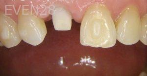 Ernest-Wong-Dental-Implants-before-2c