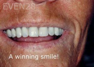 Ernest-Wong-Full-Mouth-Dental-Implants-after-1