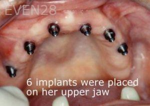 Ernest-Wong-Full-Mouth-Dental-Implants-before-1