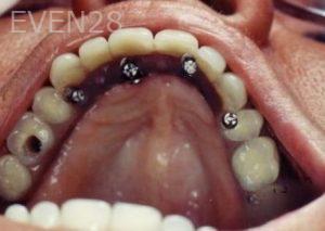 Ernest-Wong-Full-Mouth-Dental-Implants-before-1b