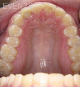Ernest-Wong-Invisalign-Clear-Aligners-after-2b