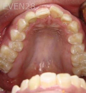 Ernest-Wong-Invisalign-Clear-Aligners-before-2b