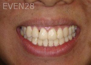 Ernest-Wong-Orthodontic-Braces-after-2